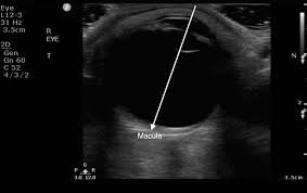 Ocular Ultrasound